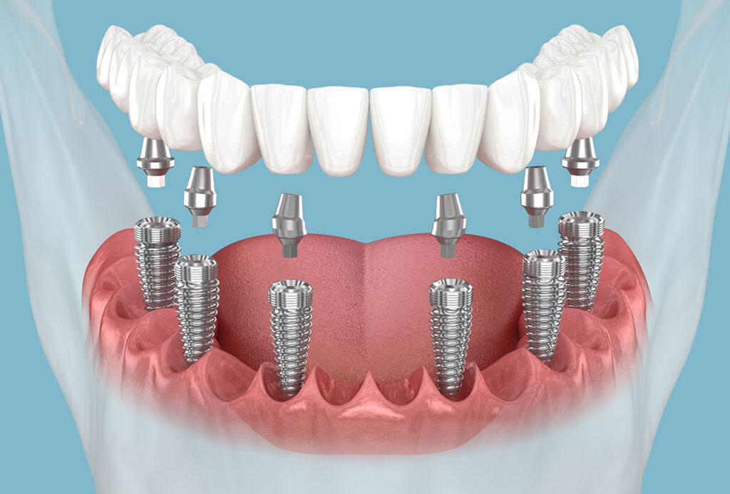 All-on-X Implants in Houston Heights: Understanding Full-Arch Tooth Replacement