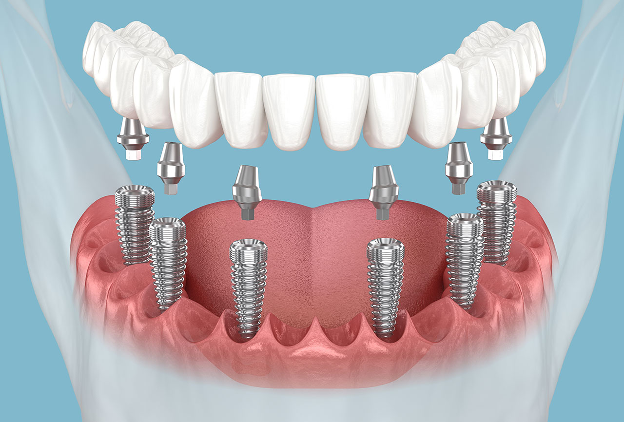 All-on-X Implants in Houston Heights: Understanding Full-Arch Tooth Replacement