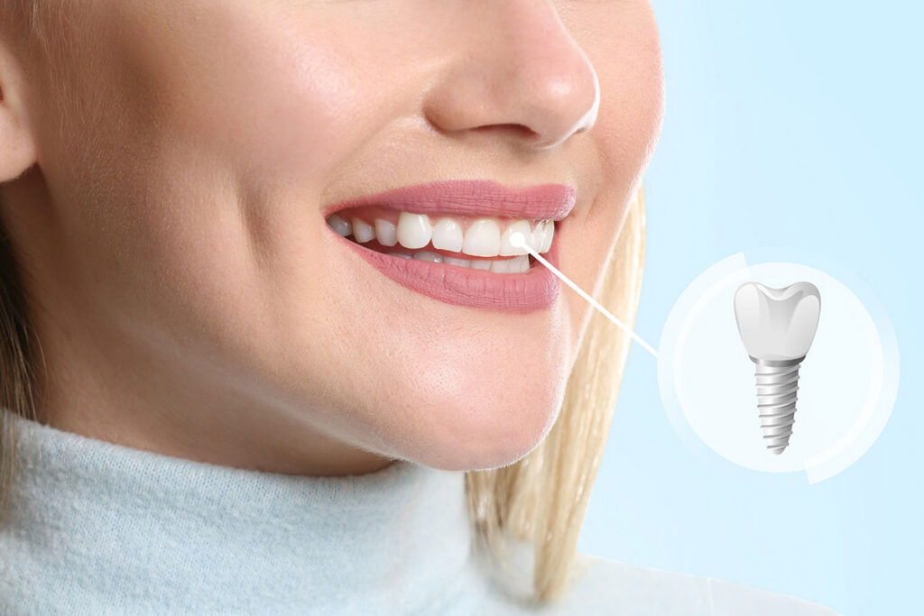 Dental Implants in Houston Heights: A Practical Guide to Replacing Missing Teeth