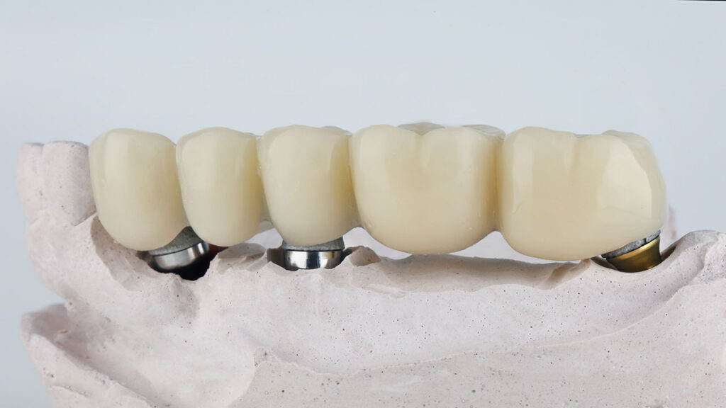 Implant Bridge in Houston Heights: A Stable Option for Replacing Multiple Missing Teeth