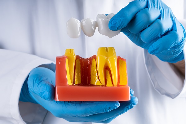 What Is A Dental Bridge?