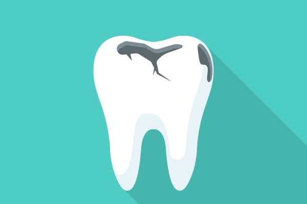 Does Every Cavity Need A Dental Filling?