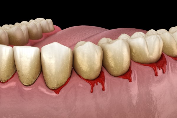 Signs And Symptoms Of Gum Disease